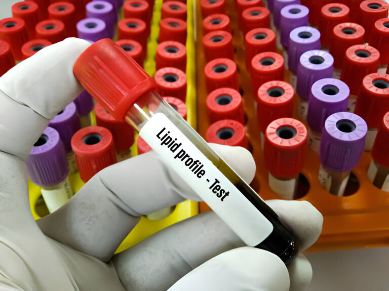 Lipid Profile Test in Amritsar