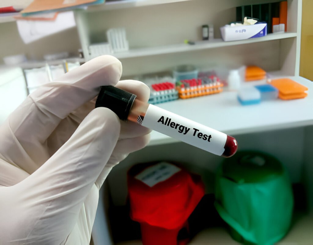 Allergy Test in Amritsar
